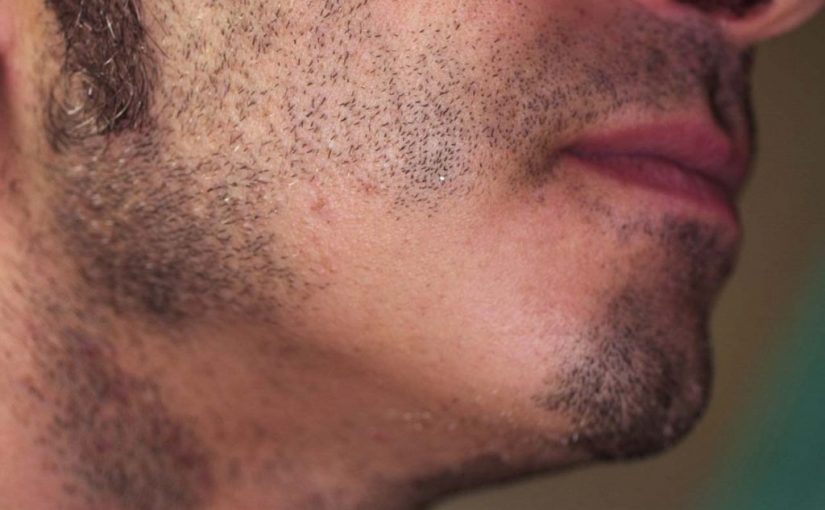 علاج ثعلبة الذقن