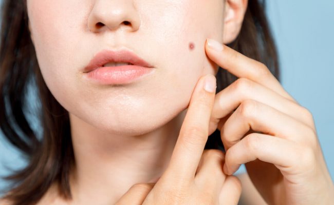 أسباب الزوائد الجلدية في الوجه