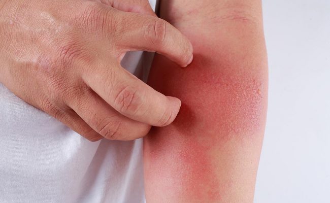 أسباب الهرش في الجسم