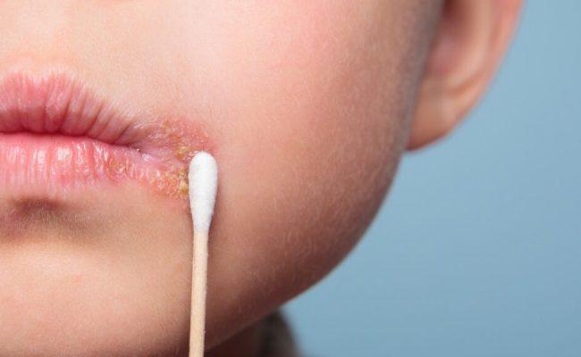 أسباب ظهور الحبوب حول الفم والذقن