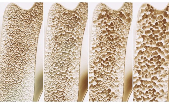 أعراض هشاشة العظام في الأرجل