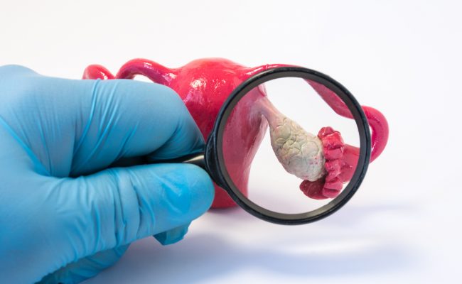 الأكل الممنوع لمرضى تكيس المبايض