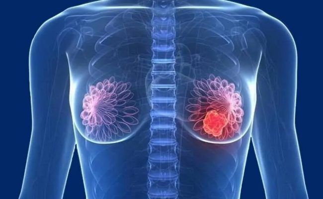 الفرق بين الغدد اللبنية والسرطان