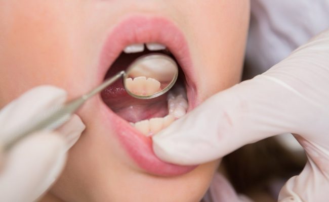 الفرق بين خراج اللثة خراج الأسنان