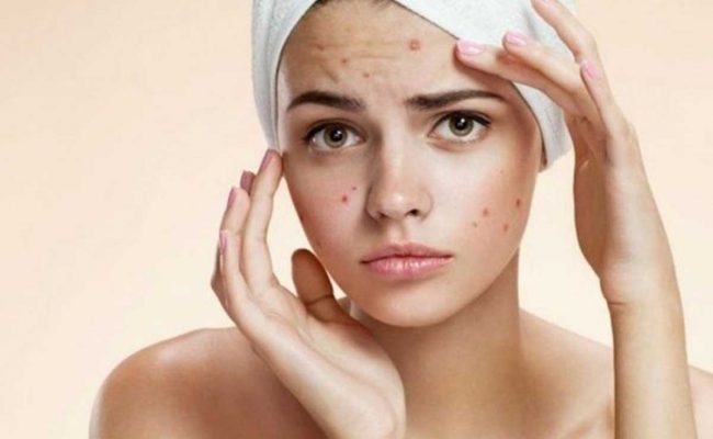 سبب ظهور الحبوب في الوجه