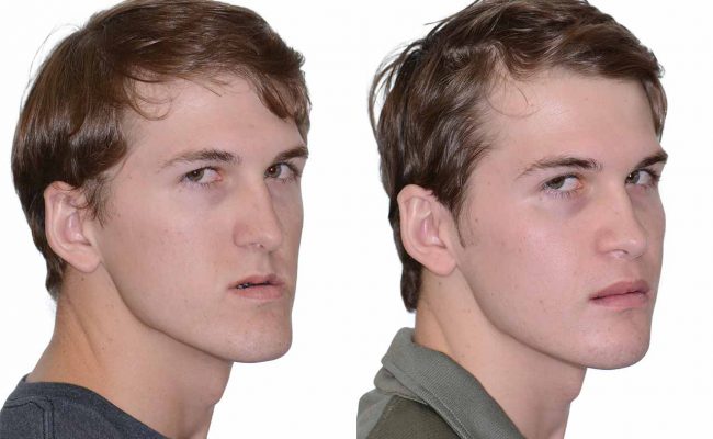 d8b9d984d8a7d8ac-d8a7d8b9d988d8acd8a7d8ac-d8a7d984d981d983-d8a8d8afd988d986-d8acd8b1d8a7d8add8a9-650x400-1 علاج اعوجاج الفك بدون جراحة