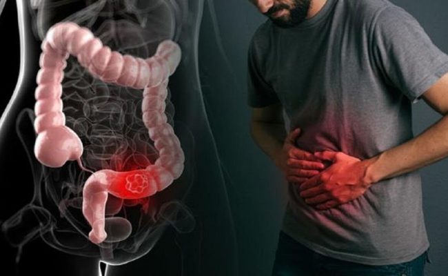 علاج الإمساك الشديد مع البواسير