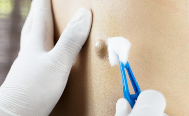 علاج الكيس الدهني بزيت الزيتون