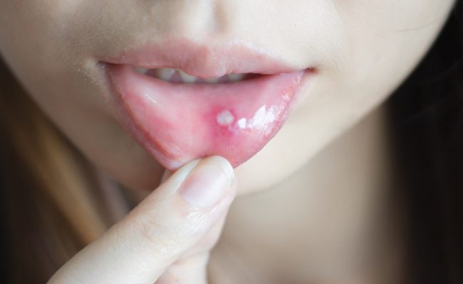 علاج تقرحات الفم بالملح
