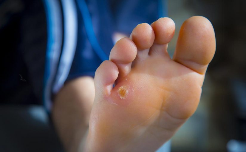 علاج مسمار القدم