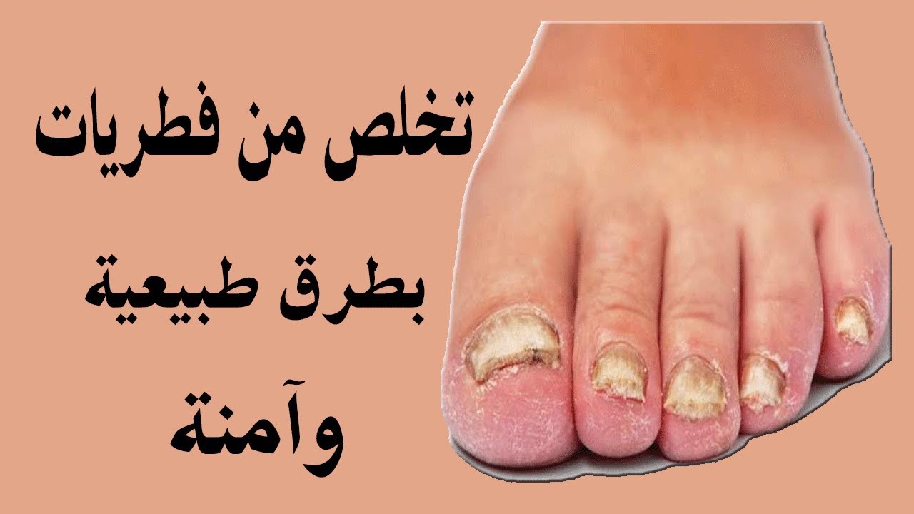 علاج فطريات القدم علاج فطريات القدم