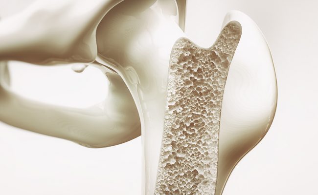 كيف أتخلص من هشاشة العظام