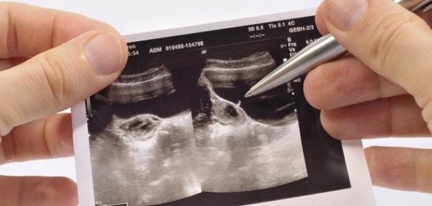 كيف ينزل كيس المبيض مع الدورة