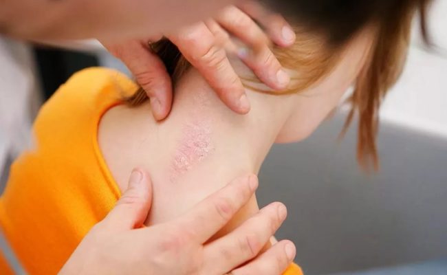 ماهو مرض الفراشة