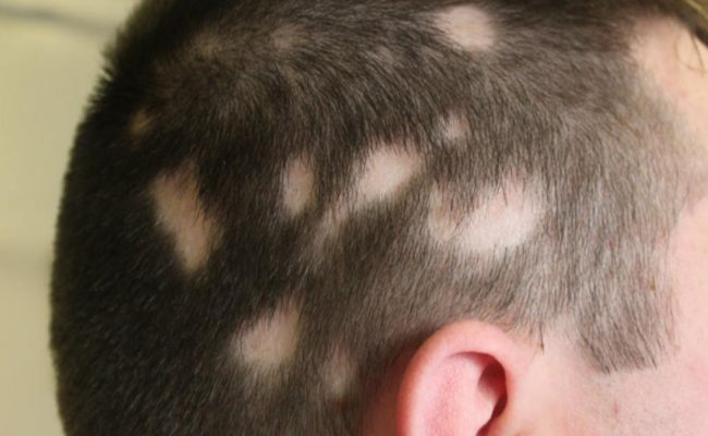 متى تكون الثعلبه خطيره