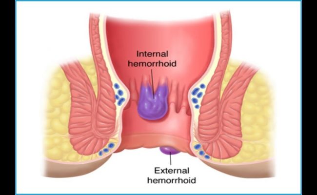 مدة الشفاء من عملية البواسير بالليزر