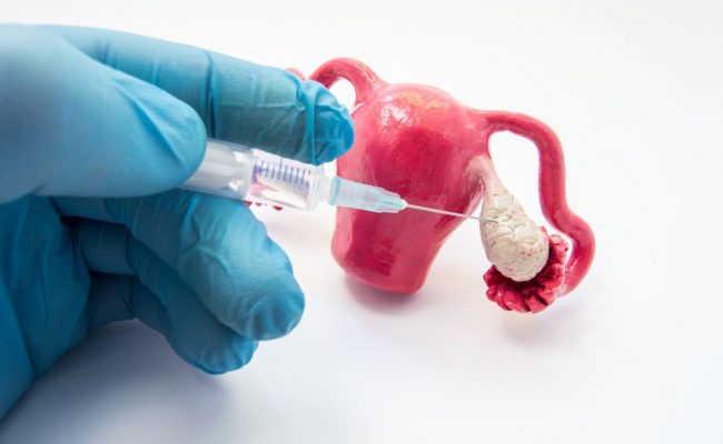 هل فرط التنشيط يؤثر على مخزون المبيض