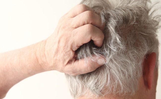 كريم لعلاج صدفية الشعر