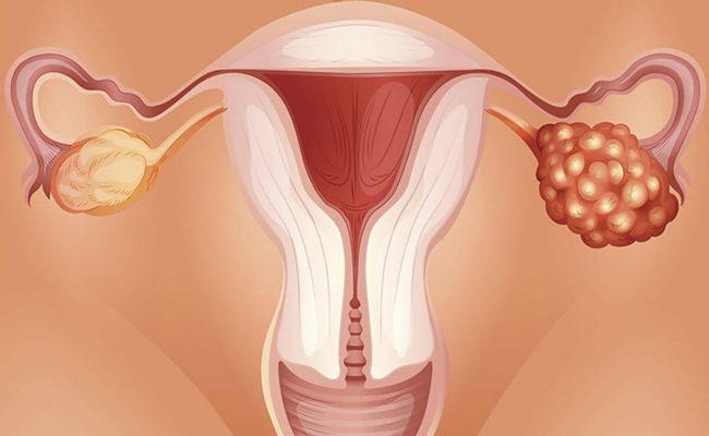 أفضل عشبة لتكيس المبايض